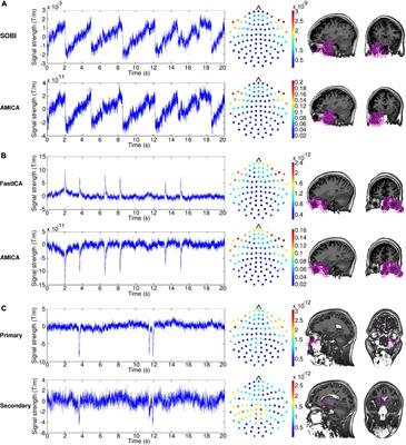 Removing ocular artifacts from magnetoencephalographic data on naturalistic reading of continuous texts